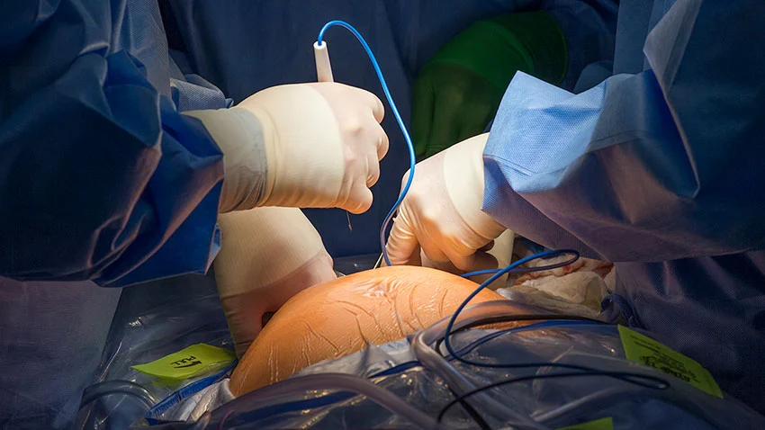Fetal surgery anesthesia